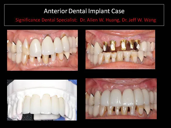 anterior dental implant - Las Vegas, NV