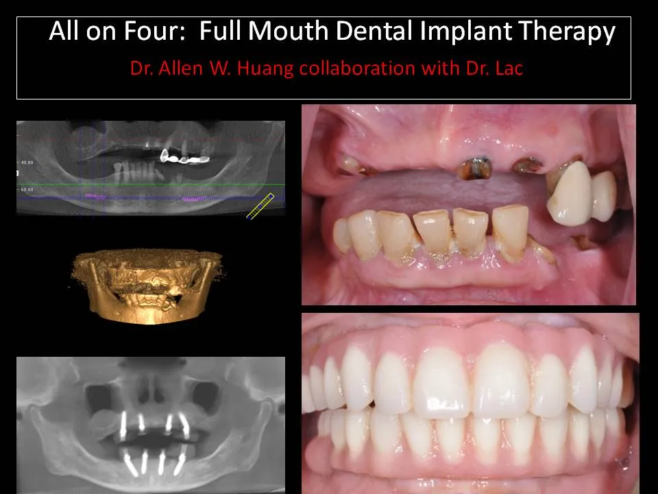 Double arch all-on-four dental implants - Las Vegas, NV