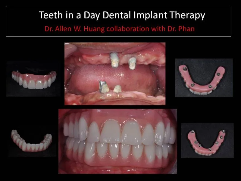 Double arch teeth-in-a-day - Las Vegas, NV