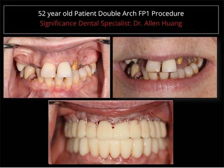 Double arch FP1 full-mouth rehabilitation - Las Vegas, NV