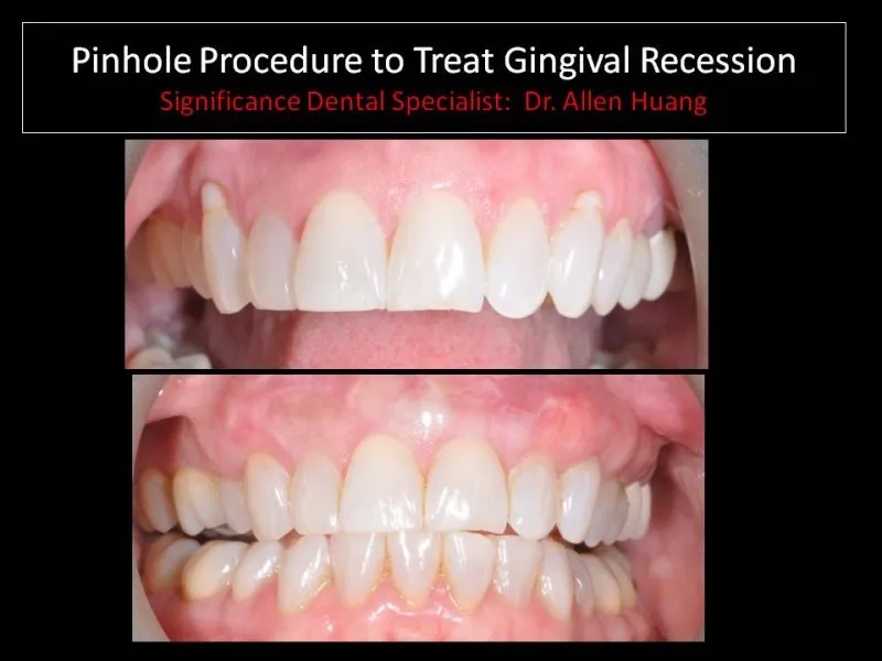 PST teeth 6-11 case study - Las Vegas, NV