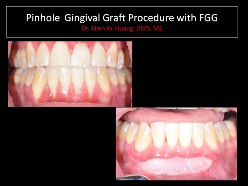 PST with free gingival graft - Las Vegas, NV