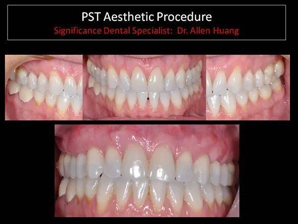 Pinhole surgical technique maxillary - Las Vegas, NV