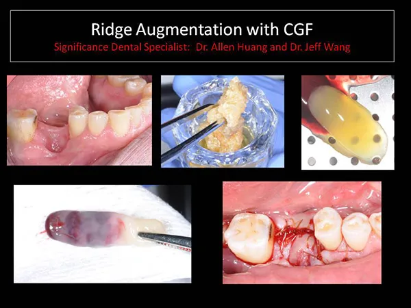 ridge augmentation - Las Vegas, NV