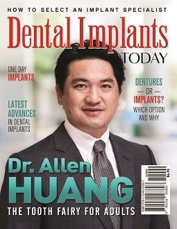 Dental Implants Today - Dr. Allen Huang