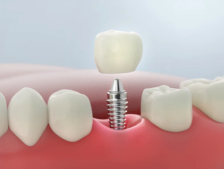 Single Tooth Implant dental implants