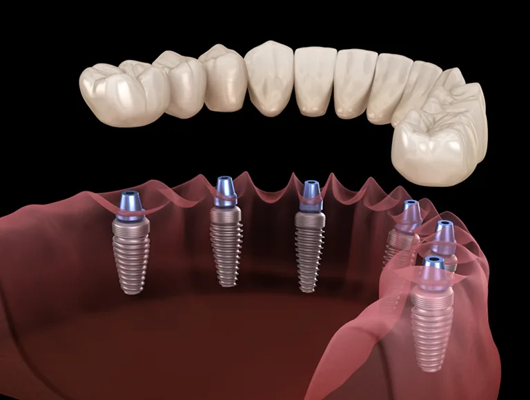 All-on-X Dental Implants