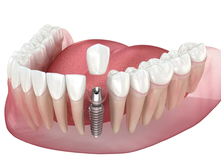 Dental Implant Restorations