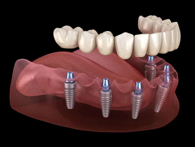 Full Arch Dental Implants