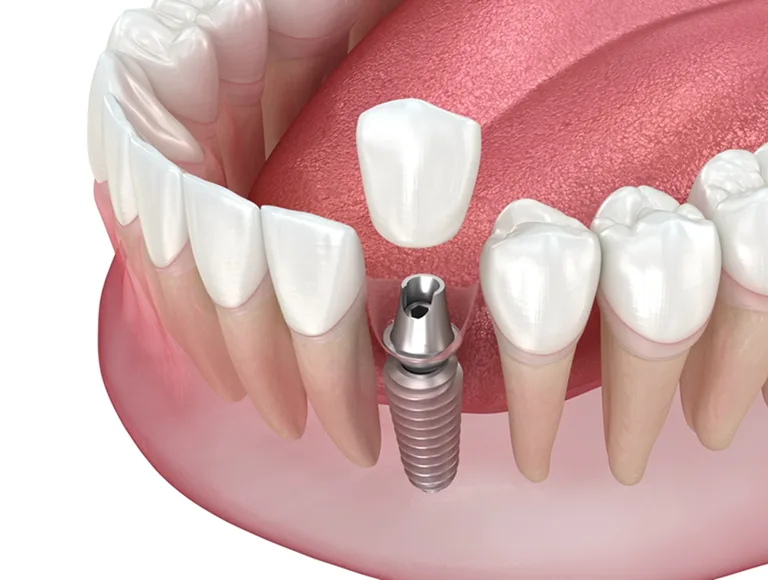 Single Tooth Dental Implants