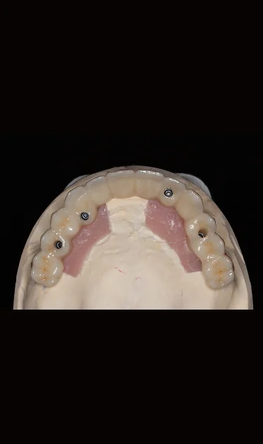 All-on-4 Zirconia dental implants