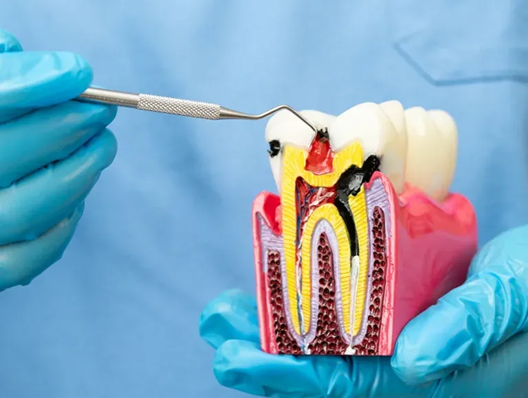 Root canal procedure at Significance Dental