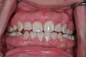 after crown lengthening - Las Vegas, NV