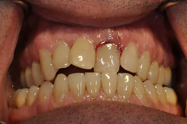 before dental implant - Las Vegas, NV