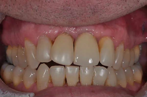 after dental implant - Las Vegas, NV