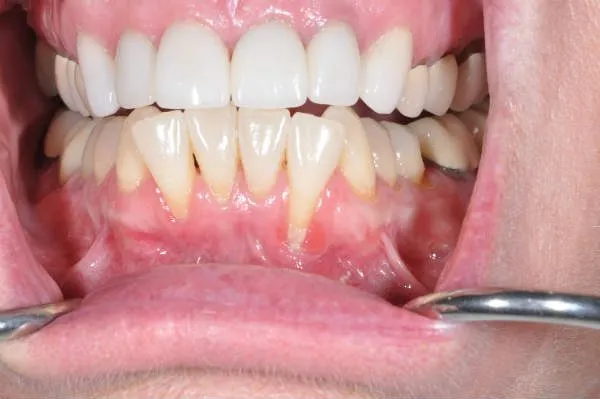 before pinhole surgery - Las Vegas, NV