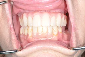 after full arch replacement - Las Vegas, NV