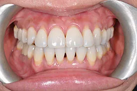 before gum graft - Las Vegas, NV