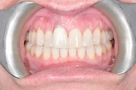 before gum graft - Las Vegas, NV