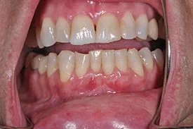after gingival graft - Las Vegas, NV
