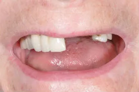 before dental bridge - Las Vegas, NV