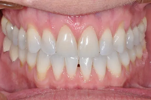 before pinhole surgery - Las Vegas, NV