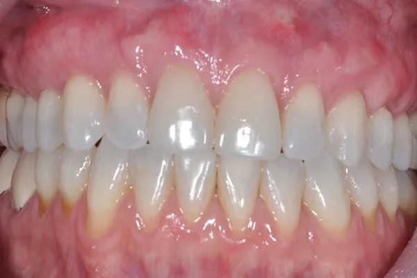 after pinhole surgery - Las Vegas, NV