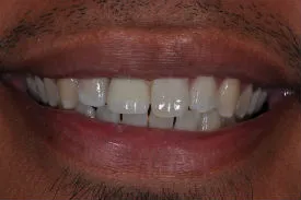 after dental implant - Las Vegas, NV
