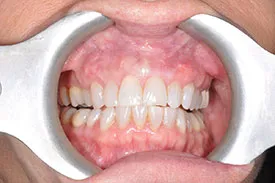 before soft tissue graft - Las Vegas, NV