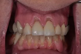 before gum recession treatment - Las Vegas, NV