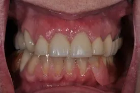 after gum recession treatment - Las Vegas, NV