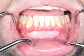 after tissue graft - Las Vegas, NV